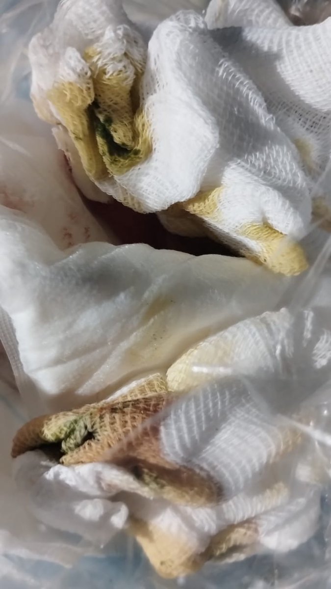 Y en una de las curaciones que le hacíamos en casa, se las realizaba una enfermera, en la parte superior de la herida empezó a salir escremento, y corrimos otra vez a urgencias, no sabiendo que era la última vez 😞 llegamos un jueves por la noche y le hicieron una tomografía 👇🏻