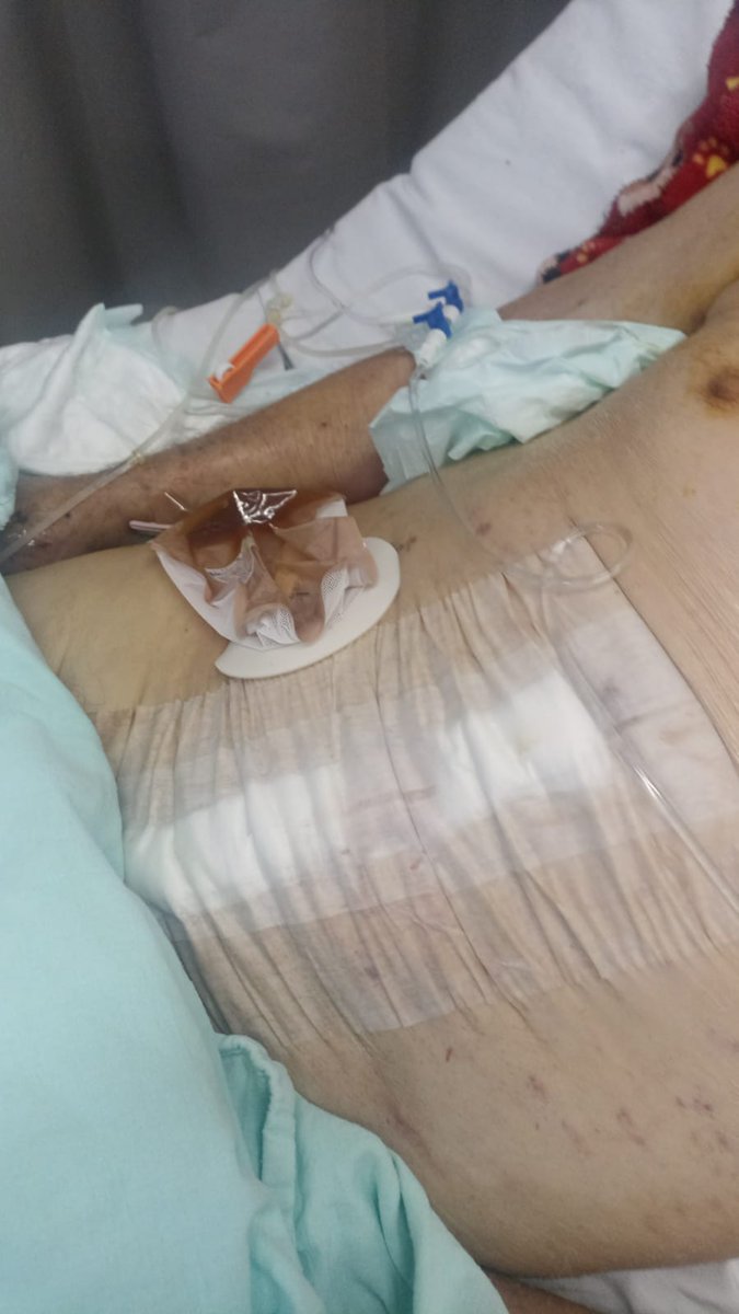 Y tenía perforado el intestino 😢 entro a cirugía de urgencia y como ya estaba muy débil y desgastado lo sacaron intubado 😞 el doctor Oliver Alejandro Bautista Ley lo volvió a operar y dijo que para el no era necesario intubar, pero que fue decisión de la anestesióloga👇🏻