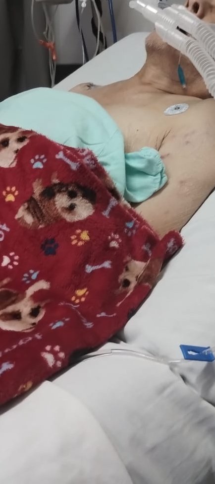 Después de esa cirugía el doctor Oliver nos dijo que teníamos que esperar 7 días para saber si no había fugas, pero como mi hermano no podía comer nada, su hemoglobina estaba en 7 era muy baja necesitaba transfusión.  Lo desintubaron tres días después le sacaron una placa de 👇🏻