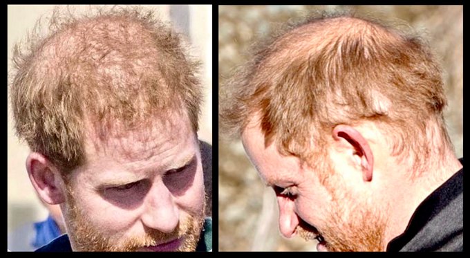 You lucked out Harry, you're not bald like your jealous big brother!