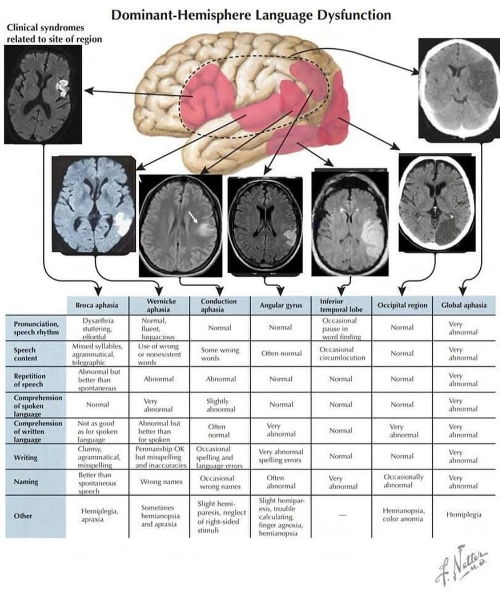 "Dominant-Hemisphere Language Dysfunction." 

facebook.com/share/14PUU1bi…