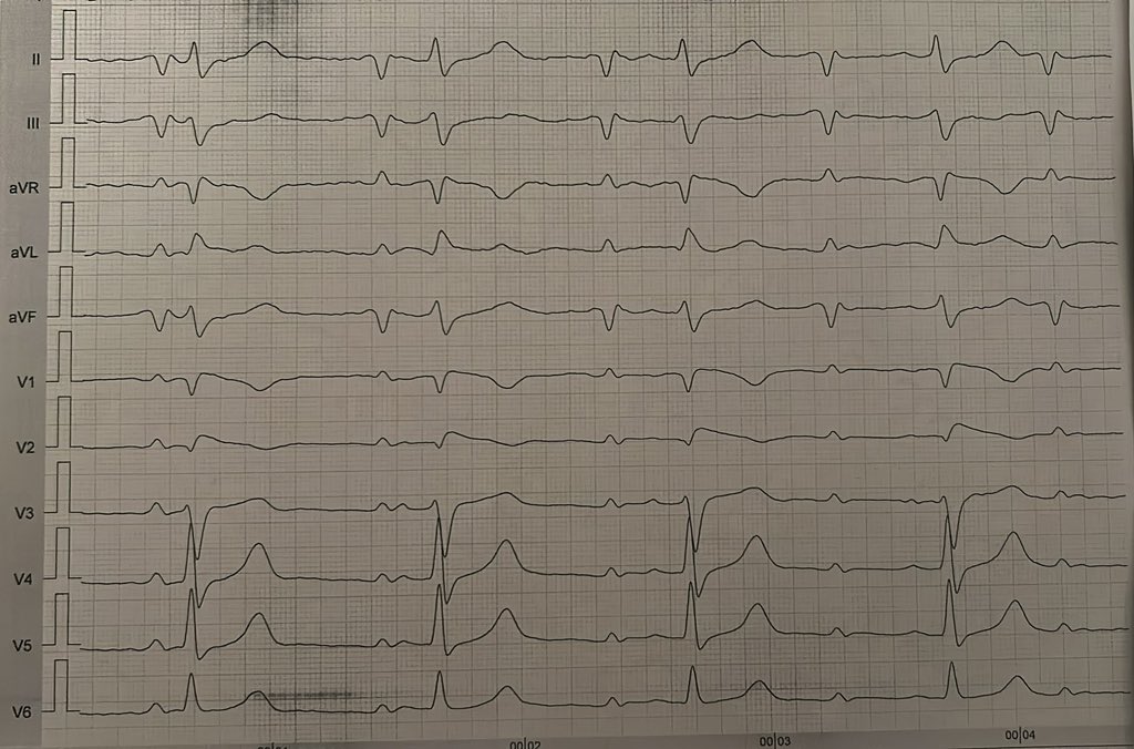 60 y old asymptomatic female patient. Previous neurologic lyme disease. Check-up GP presentation:

What do you think about this rhythm❓🧐CAVE: paper speed 50 mm/sec

#Epeeps #cardiotwitter #ECG <a href="/AlbertoAlfie/">alberto alfie</a> <a href="/adribaran/">Adrian Baranchuk MD FACC FRCPC FCCS FSIAC</a> <a href="/SergioPinski/">Sergio Pinski</a> <a href="/DrRoderickTung/">Roderick Tung</a> <a href="/MDTolgaAksu/">Tolga Aksu, MD</a> <a href="/hhuang123/">Henry D. Huang</a>