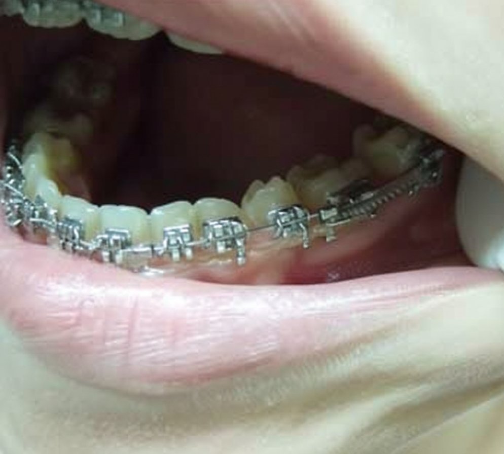 gummy_mk28's tweet photo. 昨日は調整日でした🦷
歯のすき間を動かすために右下にパワーチェーンの代わりにコイルスプリング(バネの装置)がついて、左下はパワーチェーンとバネのダブル使いに…🥺✨

結紮線があたって口内炎までできてしまい…🥲💦
痛いって言いたいけど言ったら気を遣わせちゃいそうで言えないのが一番辛い😂 https://t.co/ucqP4xwXmT