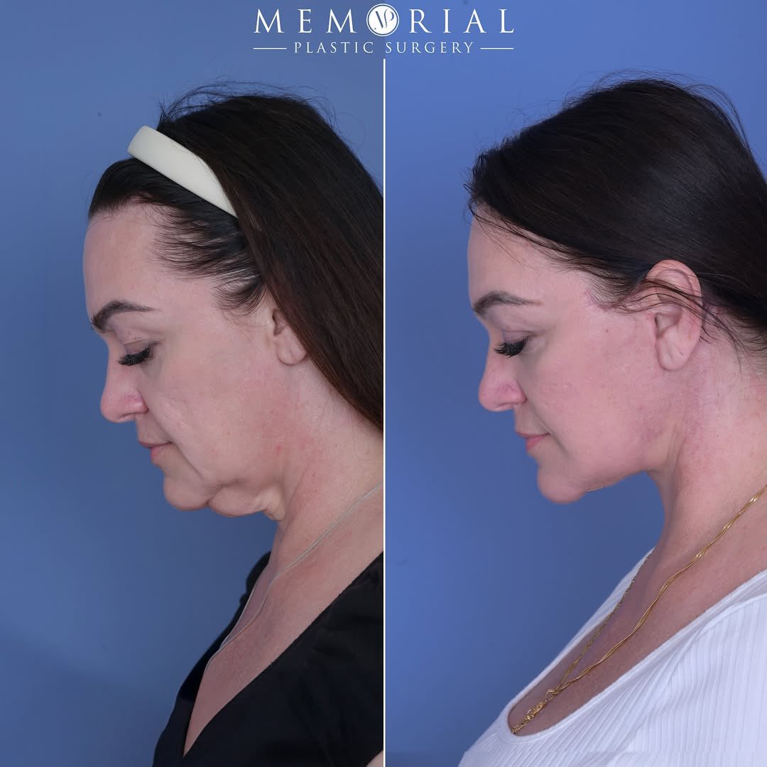 patrickhsumd's tweet image. Sharing this amazing transformation by Dr. McElwee🤩👏🏼 She’s only 1 month post-op 🔥

Procedures: Facelift, Neck Lift, Brow Lift + Upper Blepharoplasty

#MPSFace #facialplasticsurgery #facialcosmetics #houstonplasticsurgeon @memorialplasticsurgery