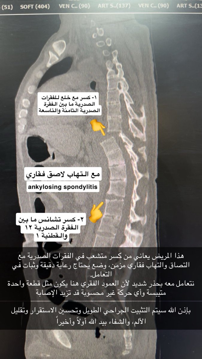 drwaleedq's tweet photo. حالة لمريض يعاني من التهاب فقاري لاصق Ankylosing Spondylitis مع كسور منتشرة وانزياح في الفقرات الصدرية والقطنية بسبب الصلابة الشديدة في العمود الفقري.

تم إجراء التوسيع للقناة الشوكية وتثبيت الفقرات جراحياً بشكل دقيق لتأمين الاستقرار وحماية الحبل الشوكي. والحمد لله خرج من العملية بوضع ممتاز ولله الفضل أولاً وأخيراً.

هذه الحالات تحتاج دقة عالية وفهم خاص لطبيعة العمود الفقري المتصلّب، وأي حركة غير محسوبة قد تزيد الإصابة. الحمد لله على التوفيق 🙏

#العمود_الفقري
#جراحة_العمود_الفقري
#SpineSurgery