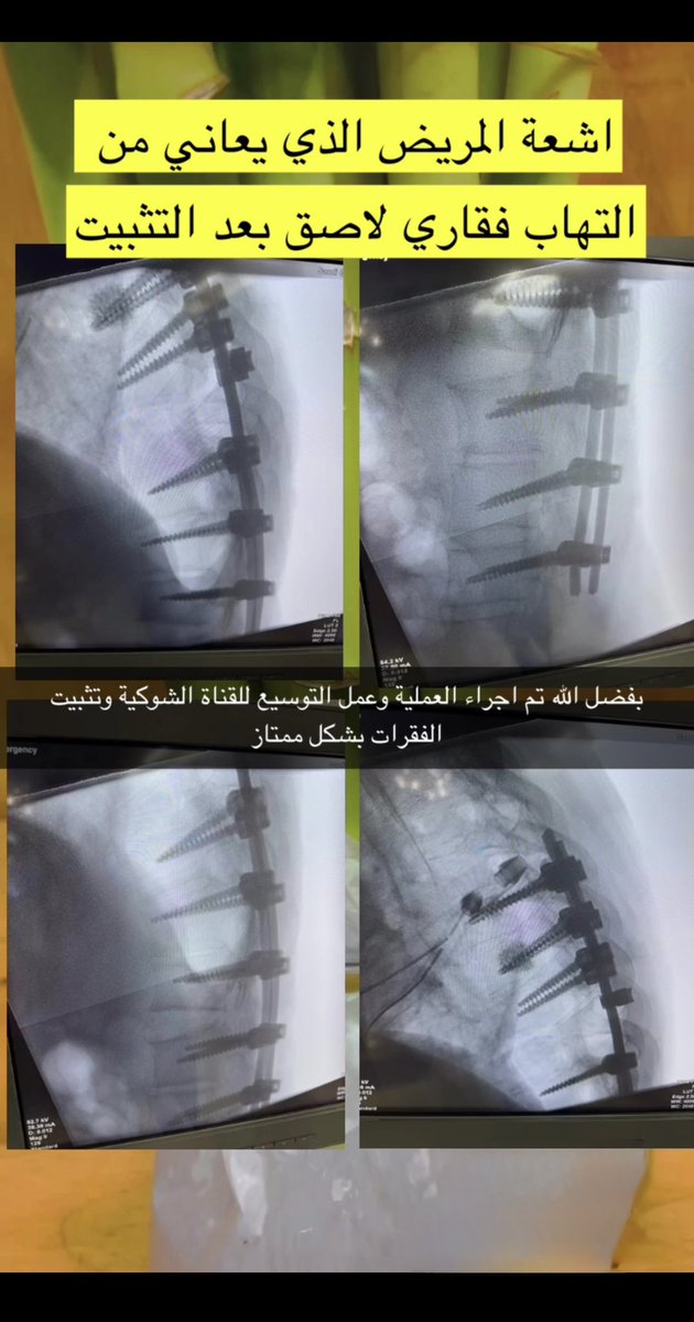 drwaleedq's tweet photo. حالة لمريض يعاني من التهاب فقاري لاصق Ankylosing Spondylitis مع كسور منتشرة وانزياح في الفقرات الصدرية والقطنية بسبب الصلابة الشديدة في العمود الفقري.

تم إجراء التوسيع للقناة الشوكية وتثبيت الفقرات جراحياً بشكل دقيق لتأمين الاستقرار وحماية الحبل الشوكي. والحمد لله خرج من العملية بوضع ممتاز ولله الفضل أولاً وأخيراً.

هذه الحالات تحتاج دقة عالية وفهم خاص لطبيعة العمود الفقري المتصلّب، وأي حركة غير محسوبة قد تزيد الإصابة. الحمد لله على التوفيق 🙏

#العمود_الفقري
#جراحة_العمود_الفقري
#SpineSurgery