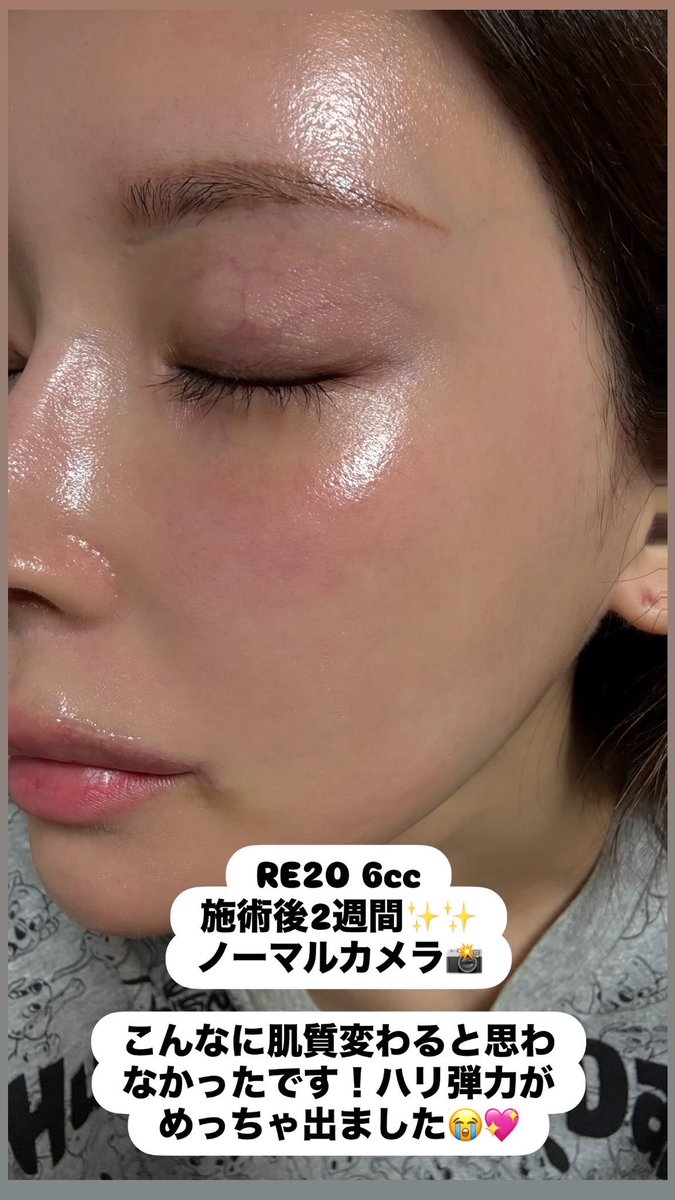 コンパス 顔面骨の整美と治療 裁断済⭐︎ コンパス 顔面骨の整美と治療