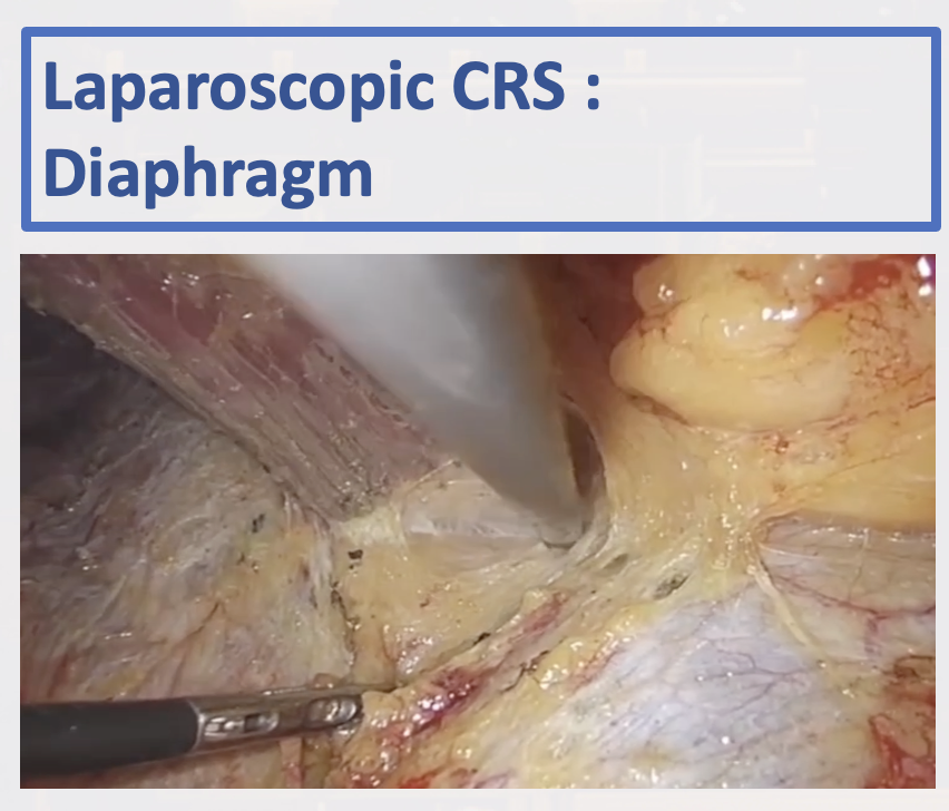 MufaddalKazi's tweet image. An eventful @PSOGI_EC 2025 in Barcelona Last week
Presented the #HARPSICLE study proposal - international study for colorectal peritoneal metastasis 
@writeslkpushkin @CashinPtr @glehenolivier 
Also presented our video technique and outcomes of Minimally invasive CRS