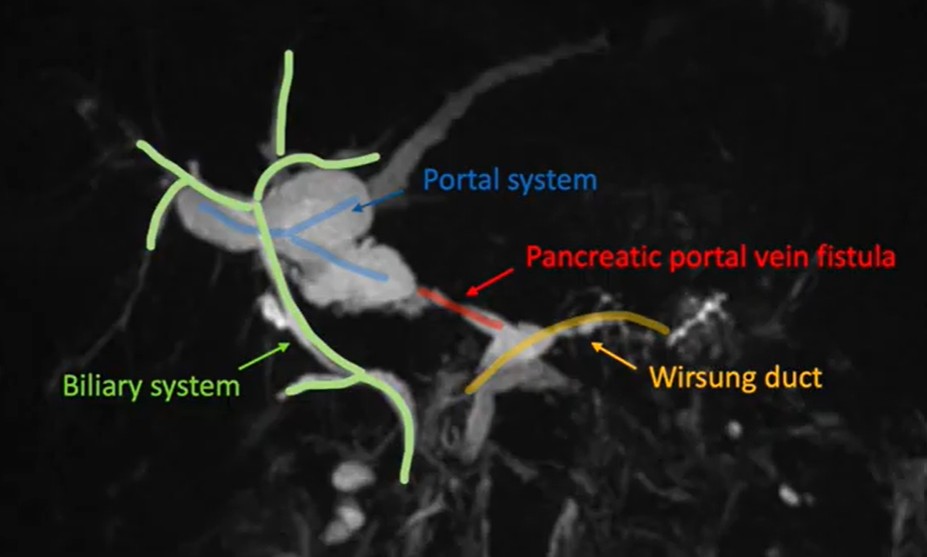 videogie's tweet image. Fabrizio Termite, MD, et al show pancreatic stenting by endoscopic retrograde pancreatography for management of a pancreatico-portal vein fistula with the achieved therapeutic results. youtu.be/JvEIO91Gu24

#GITwitter