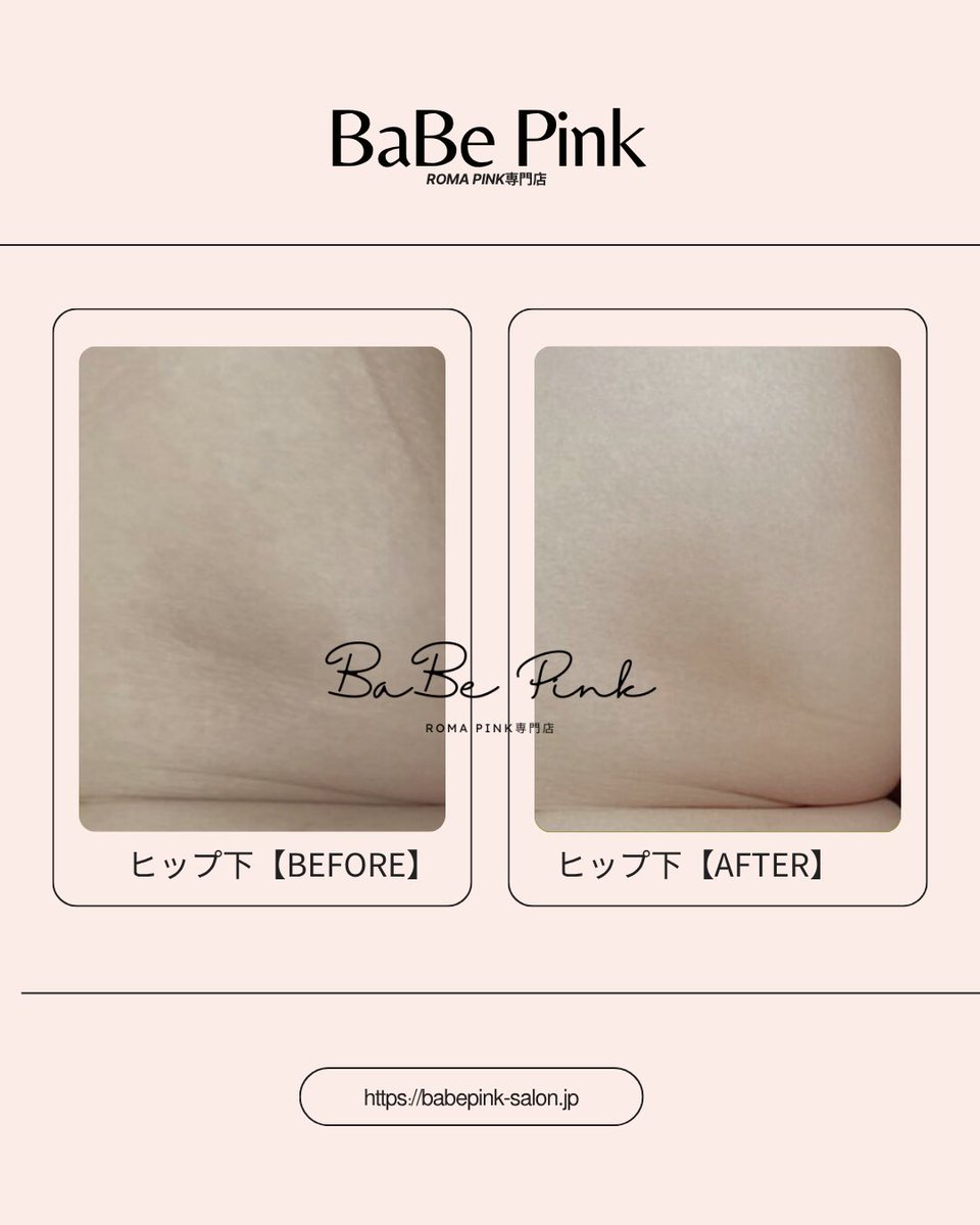 BaBePink_Tokyo's tweet photo. 痩せ型の方は
ヒップ下が圧迫で黒ずみやすい傾向。

ローマピンク後は
円座クッションで保護が大切。

摩擦と圧迫を避けるだけで
仕上がりが変わります。 https://t.co/lHnIBC3nT3