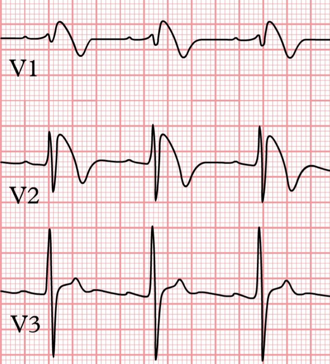 ECG spot Diagnosis 
Case 24

A 41 yrs Southeast Asian presents with syncope. He has a family history of sudden cardiac death at <45 years old.

1. Diagnosis ?
2. Treatment ?