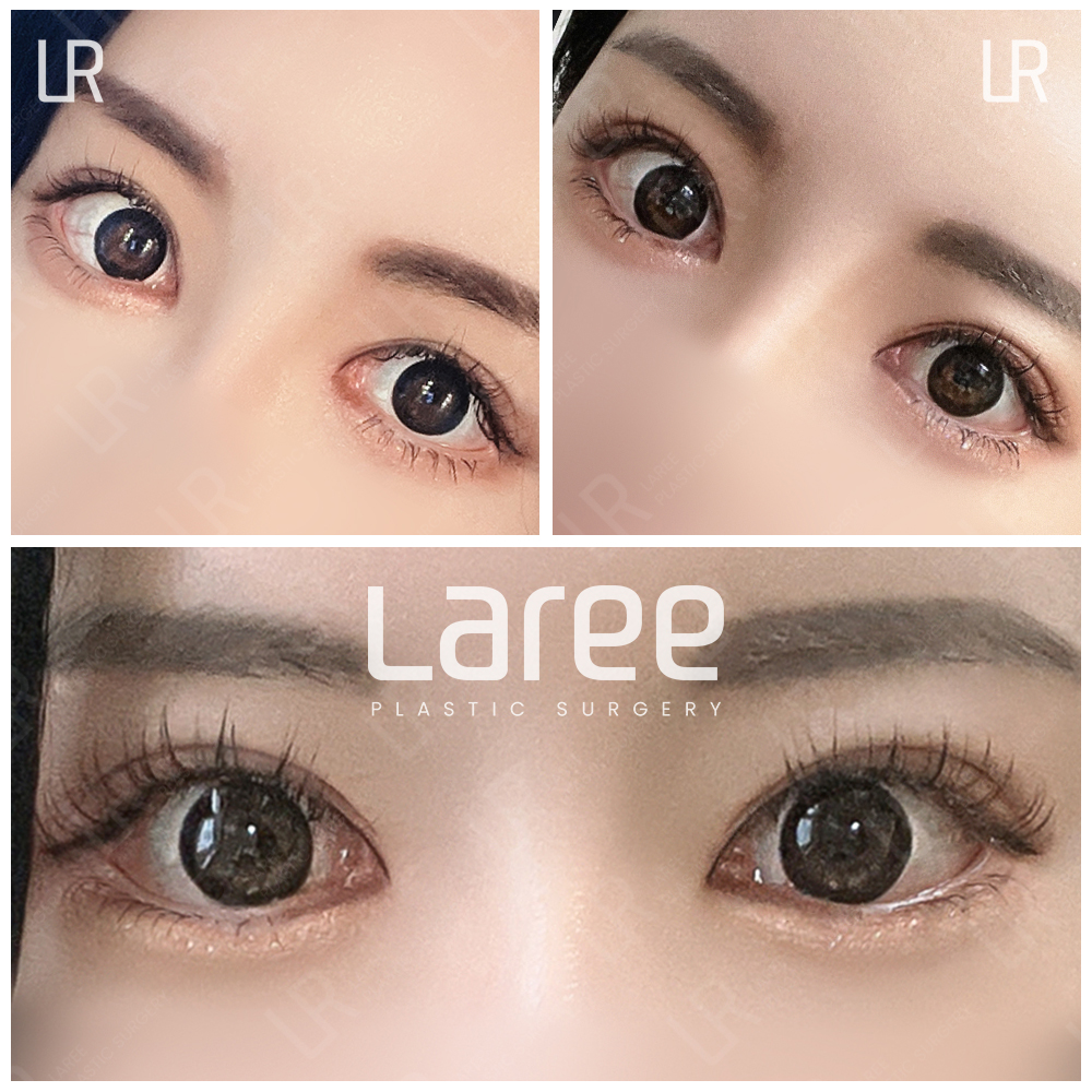 lareeclinic's tweet photo. 過去の下まぶたの手術でできた三白眼と
厚い二重ラインを改善するために、

🌹 二重ライン修正＋下まぶた再手術＋目尻切開（再手術）を行いました！

今は目元がずっとやわらかく、自然な印象になりました✨

#韓国整形 #目再手術 #二重ライン修正 #目尻切開

← before　|　after → https://t.co/UozBqzT2yI