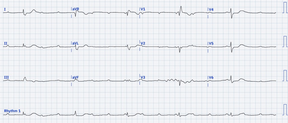 EcgOxford's tweet image. Rhythm?
@akneton @yolyabreuh @UlhasDr @DidlakeDW @ecgrhythms @IhabFathiSulima @DrPharmDMDTh
@Vadeboncoeur_Al @smithECGBlog @EM_RESUS @estudiomedicina @OrlandoRPN @fxgodzeuss #EPeeps #FOAMcc @ResusMed @TrRja @NaokiThukishima @ecgandrhythmRoe