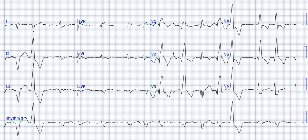 EcgOxford's tweet image. Rhythm?
@akneton @yolyabreuh @UlhasDr @DidlakeDW @ecgrhythms @IhabFathiSulima @DrPharmDMDTh @Vadeboncoeur_Al @smithECGBlog @EM_RESUS
@estudiomedicina @OrlandoRPN @fxgodzeuss #EPeeps #FOAMcc @ResusMed @TrRja @NaokiThukishima @ecgandrhythmRoe