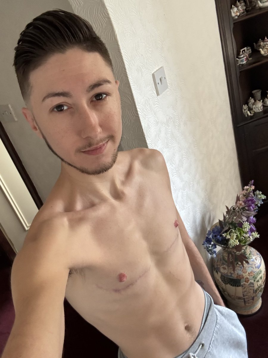 Today 7 months had top surgery ❤️🎉😃