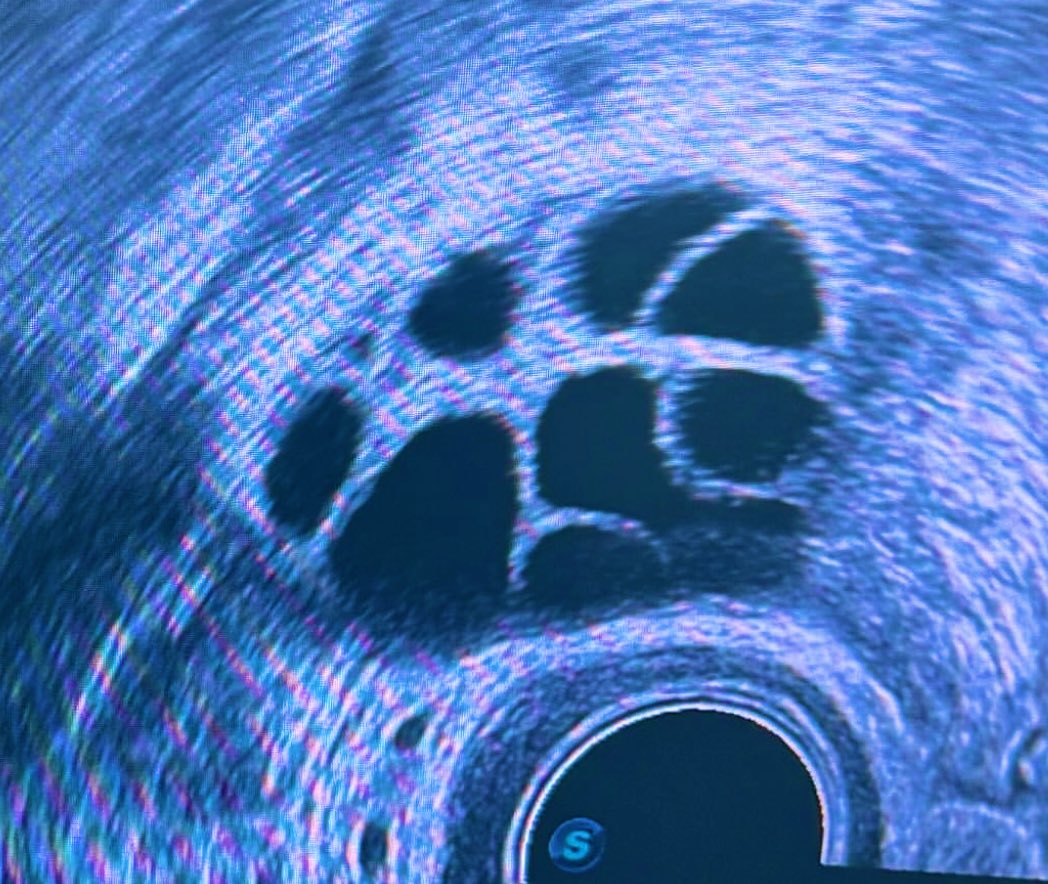 dr_pariissa's tweet image. فولیکولهای رشد یافته تخمدان پلی کیستیک دختر خانمی ۲۶ ساله که به علت ابتلا به تومور خوش خیم تخمدان, کاندید فریز تخمک شد.
#PCOS