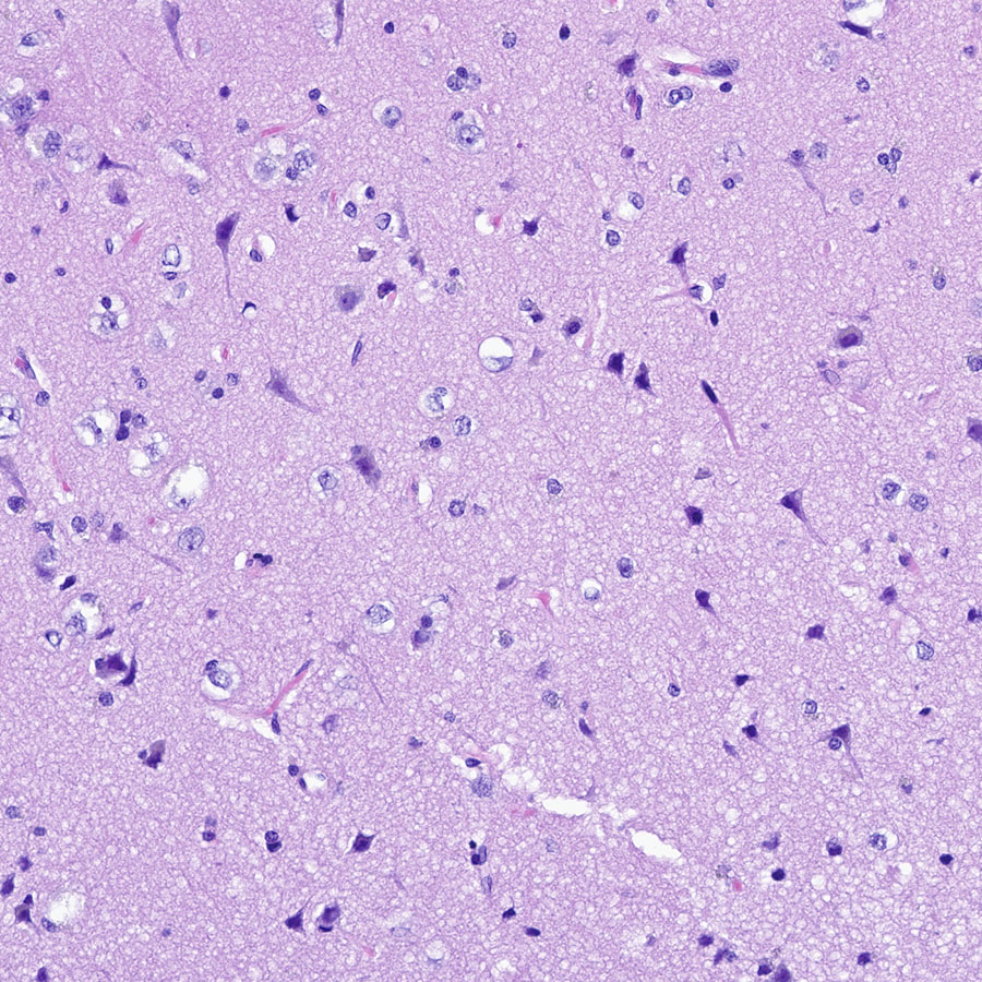 CraigHorbinski's tweet photo. This might LOOK like unremarkable cortex, but an IDH1 R132H immunostain highlights a few scattered oligodendroglioma cells lurking in the background. Tricksy!!! #pathology #neuropath #PathTwitter https://t.co/jXrU88Vyww