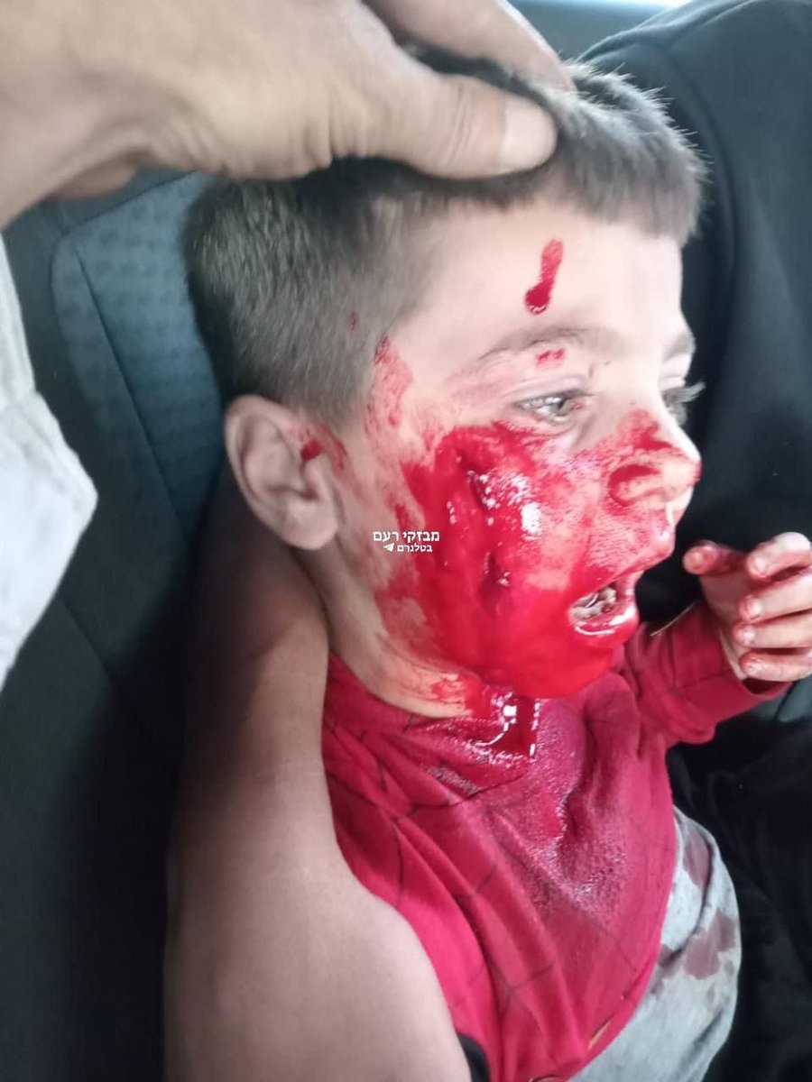 AbujomaaGaza's tweet photo. Palestinian child Adam Shantir has been wounded in Israeli jewish settler attack south of the occupied West Bank city of Al Khaleel.. https://t.co/1XgKRGQQhm