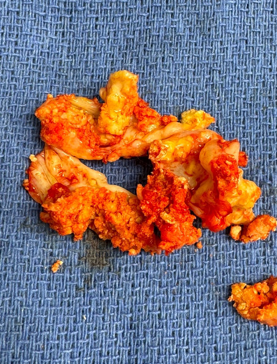 Not all aortic valves come out clean. This one was heavily calcified... had to be cut out in several pieces. Mean gradient 74mmHg.  Conduction system intact, annulus fully debrided, and a 29 mm prosthesis seated smoothly in a super athletic man.