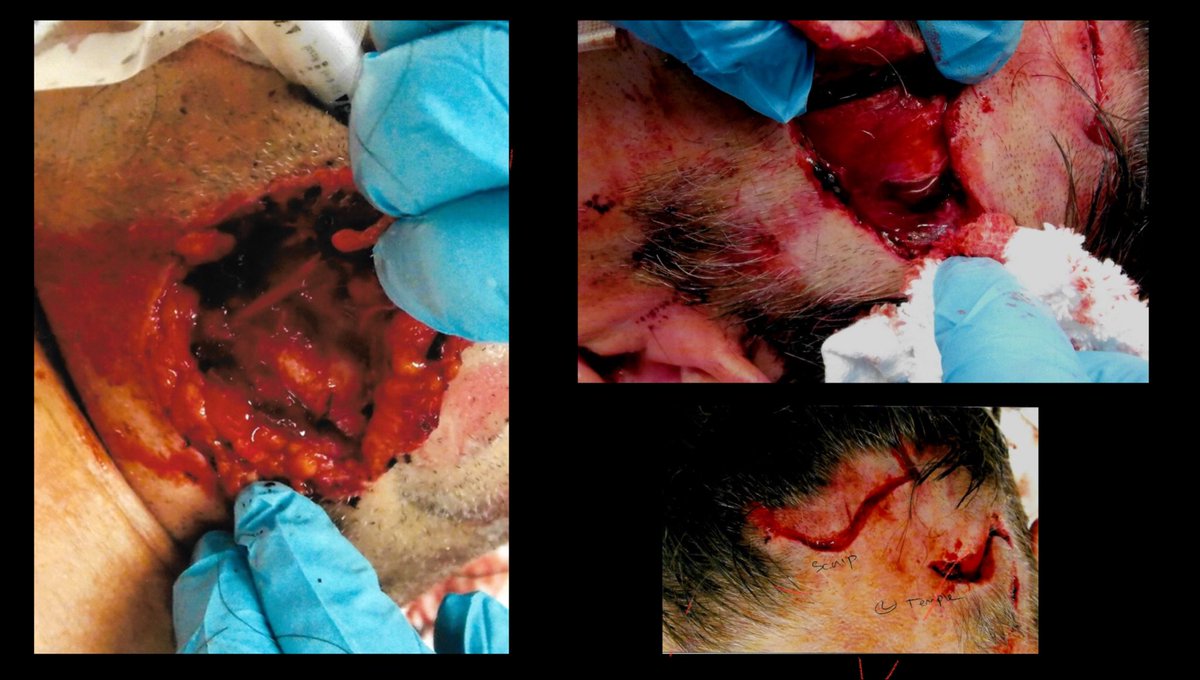 cwmatters2day's tweet photo. From the publishing of my book Wild Awakening, so many have asked to see images of my injuries. The grizzly attack was both devastating and life changing in an amazing way. https://t.co/nb4IUKVXQE