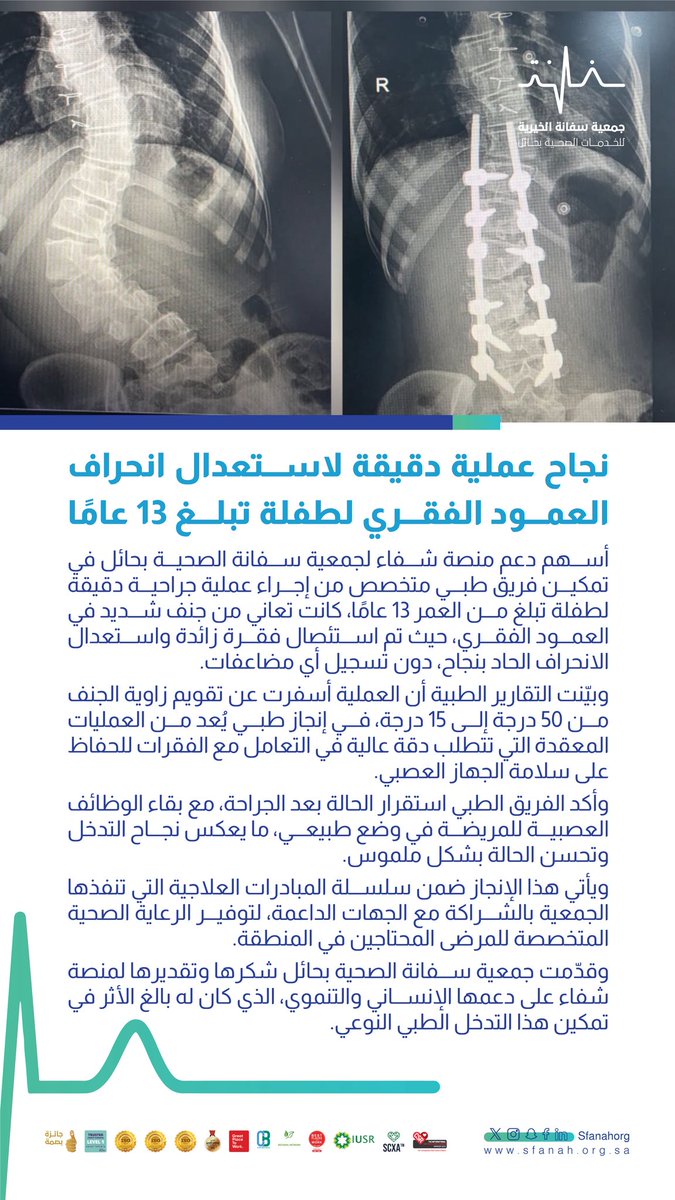 #خبر|📄
     
نجاج عميلة دقيقة لاستعدال انحراف العمود الفقري لطفلة تبلغ 13 عامًا 
    
#جمعية_سفانة|#يدك_الحانية