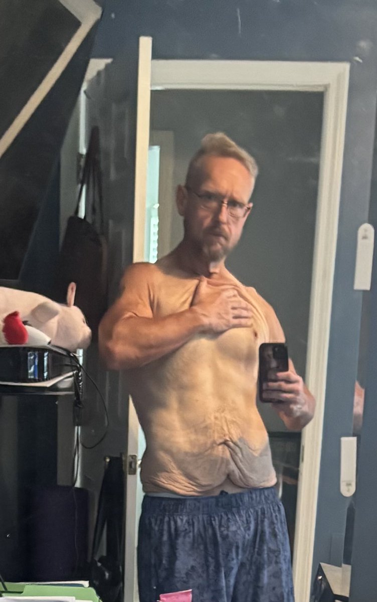 Jet_Bak's tweet photo. I lost 310 pounds. 510 to 200. When you do that you have loose skin. It’s not pleasant and it doesn’t look good. But it’s like a battle scar. Don’t let it hold you back. Wear it with pride. #weightloss #weightlossjourney #exercise #fitness #looseskin https://t.co/3wpl9HW13Y