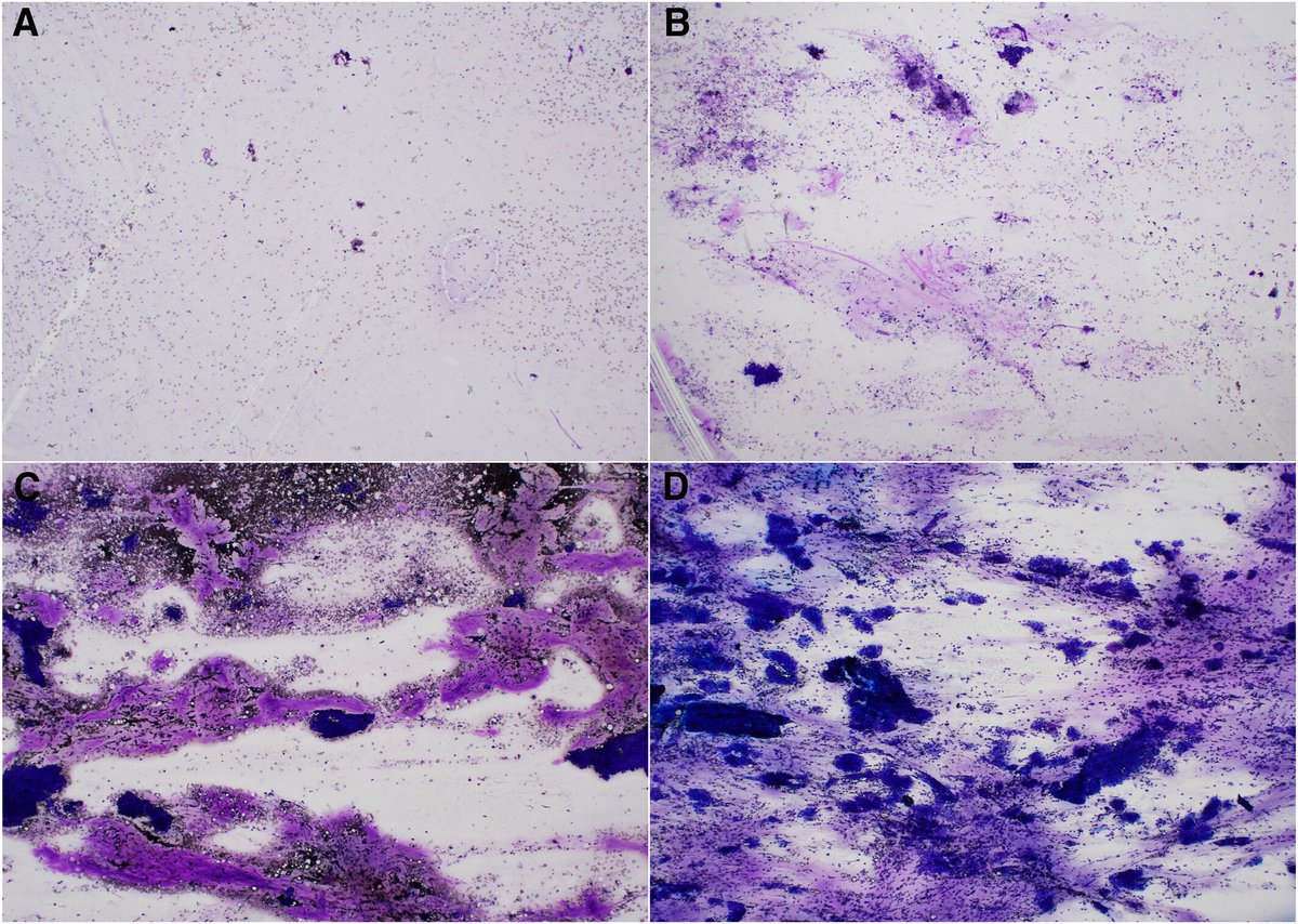 CancerCytopath's tweet image. Coming up at #ASCyto25, our Bridging The Gap Editor @SMonaco3 leads a short course w/ Dr Yi Ding on &quot;Pancreatic Cyst Fluids and Bile Duct Brushings.&quot; Dr Monaco recently co-authored this publication comparing yield in conventional &amp;amp; rotational FNA needles: acsjournals.onlinelibrary.wiley.com/doi/10.1002/cn…