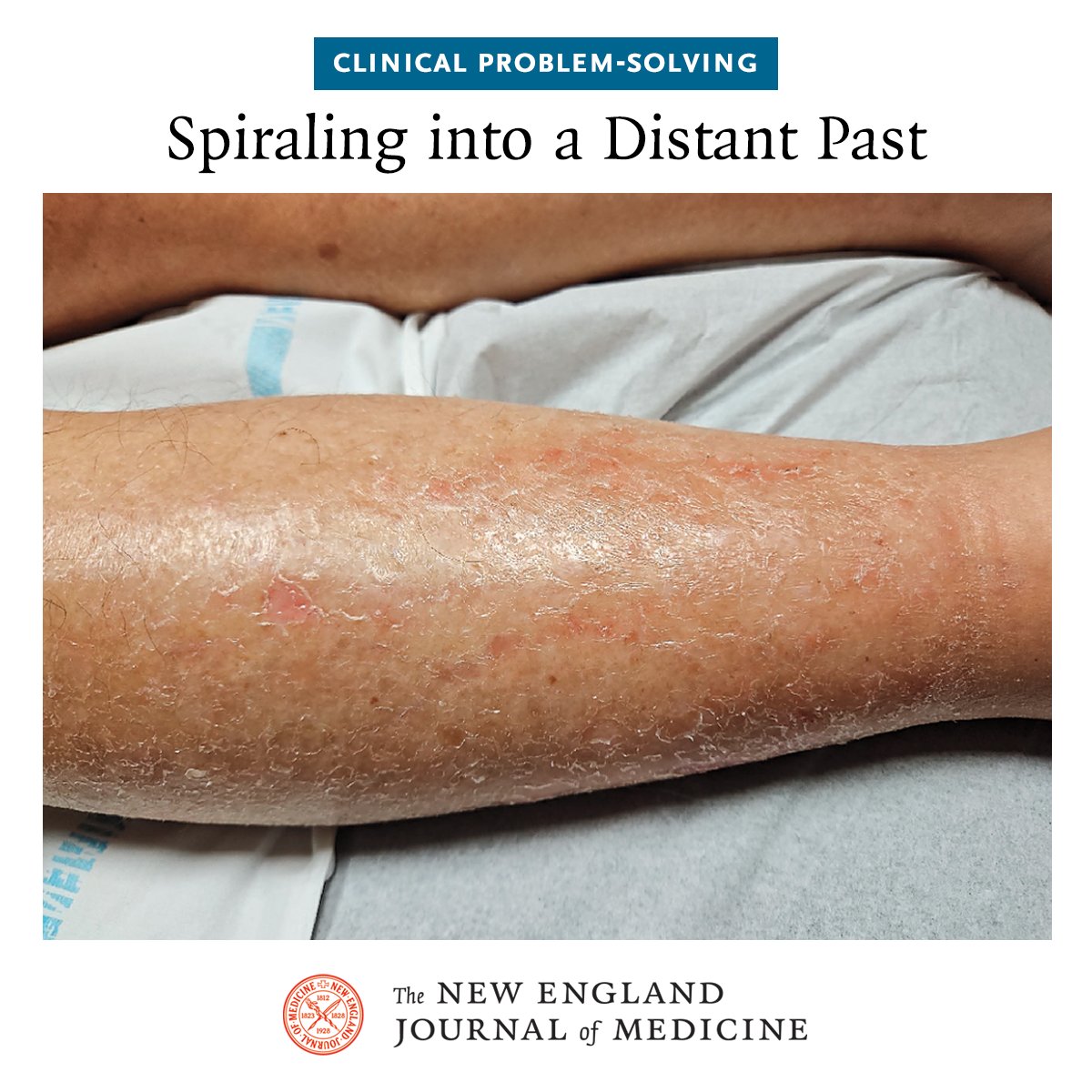 An 83-year-old man presented to the emergency department with generalized pruritus that had begun the previous night. One month earlier, he had been evaluated in the neurology department for a unilateral peripheral facial-nerve palsy. At that time, laboratory test results were