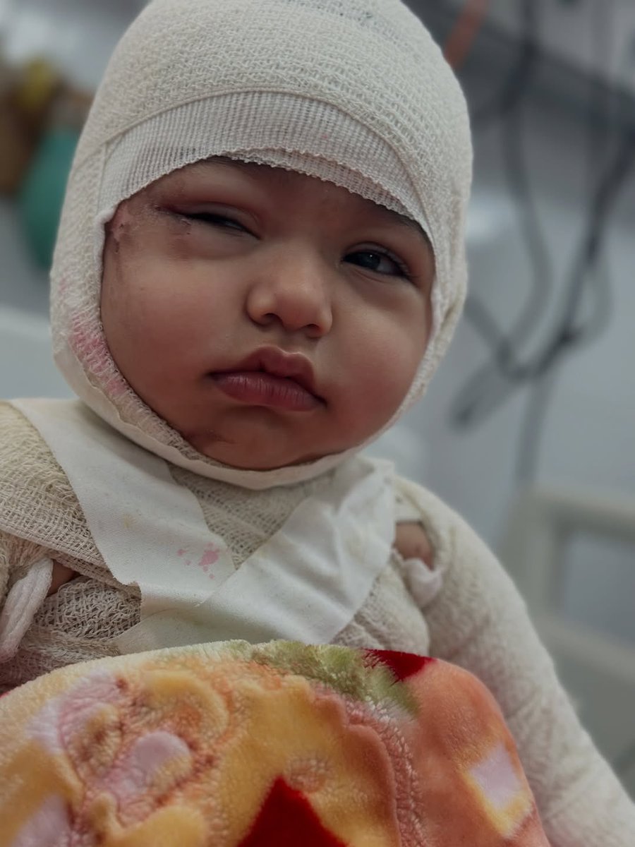 doaa_mohammad71's tweet image. The 3-year-old girl, Hidaya, suffered third-degree burns from rockets fired by the occupation that targeted her family&apos;s home in Gaza.

#gaza #genocide