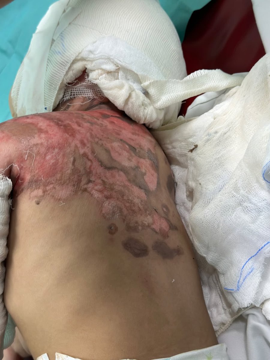 doaa_mohammad71's tweet image. The 3-year-old girl, Hidaya, suffered third-degree burns from rockets fired by the occupation that targeted her family&apos;s home in Gaza.

#gaza #genocide