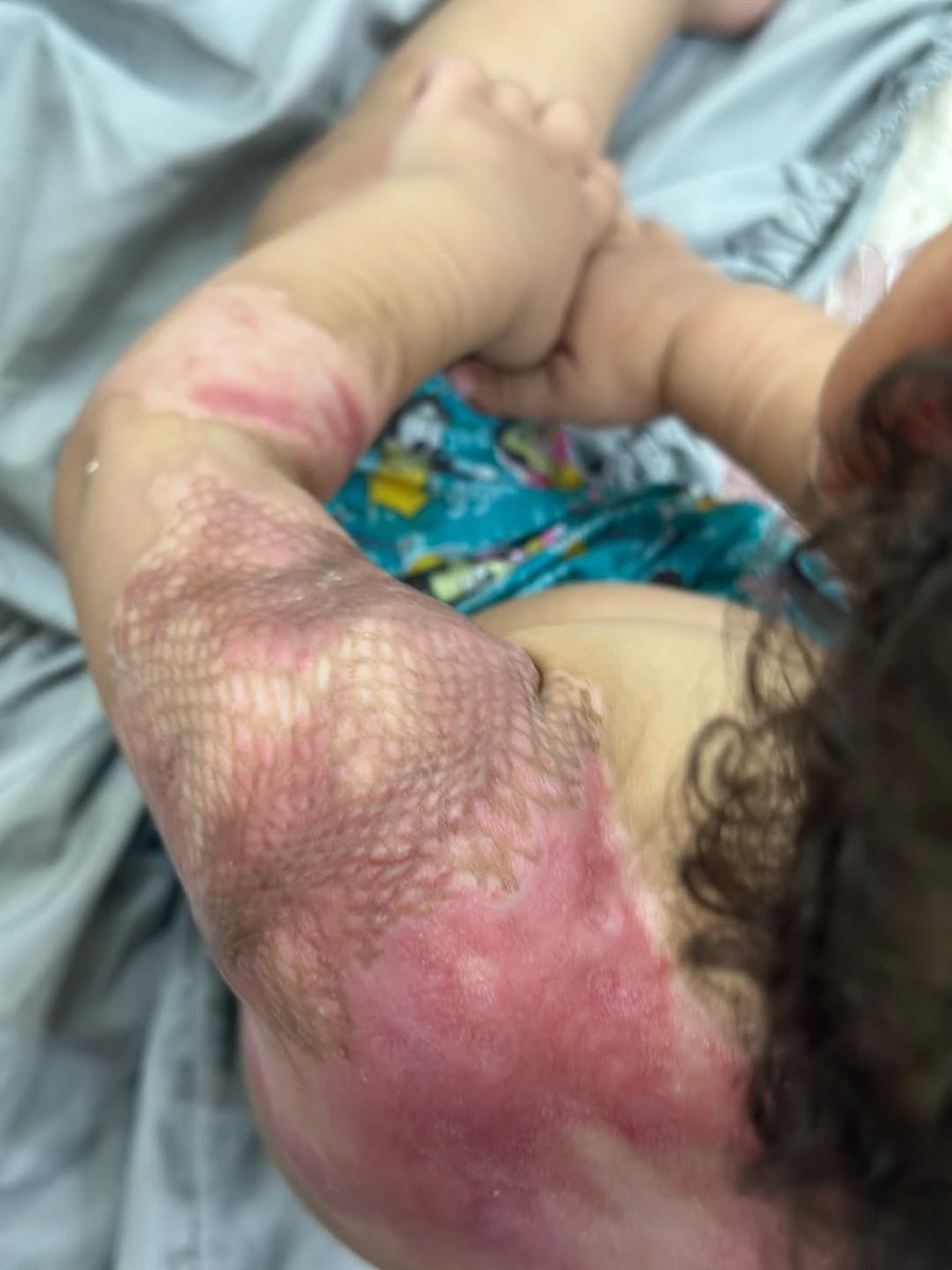 doaa_mohammad71's tweet image. The 3-year-old girl, Hidaya, suffered third-degree burns from rockets fired by the occupation that targeted her family&apos;s home in Gaza.

#gaza #genocide