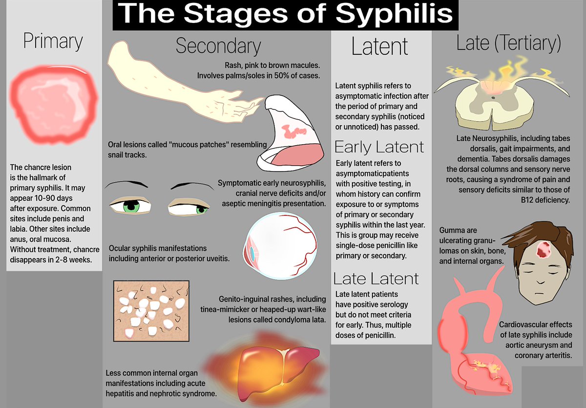 USMLEStepStudy's tweet image. Stages of syphilis infection- 
-Primary stage (chancre at ~3 wks)
-Secondary stage (systemic dissemination at ~ 6 - 12 wks,
-Latent stage, with tertiary complications (e.g., gummatous dz, CV syphilis, paresis, tabes dorsalis)...yrs later if infection not treated
-Tertiary (Neuro)