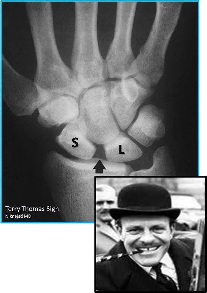radRounds's tweet photo. Classic #cotd - "Terry Thomas" sign as seen as scapholunate widening or gap. 

Read more about this fascinating case on radRounds - https://t.co/I2oUM6M6of; courtesy of M.T. Niknejad, MD. 

#MSKrad #cotd #xray #terrythomas #radtwitter #radx https://t.co/s9E6POVElA