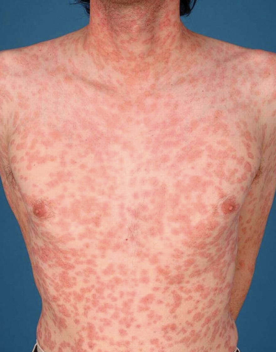 USMLEStepStudy's tweet image. Secondary syphilis - s/s: rash, lymphadenopathy, fever, malaise, hepatitis (cholestatic pattern), high alkaline phosphatase, membranous nephropathy (immune complex deposition); Dx: T. pallidum hemagglutination assay, fluorescent treponemal antibody absorption test, RPR, VDRL