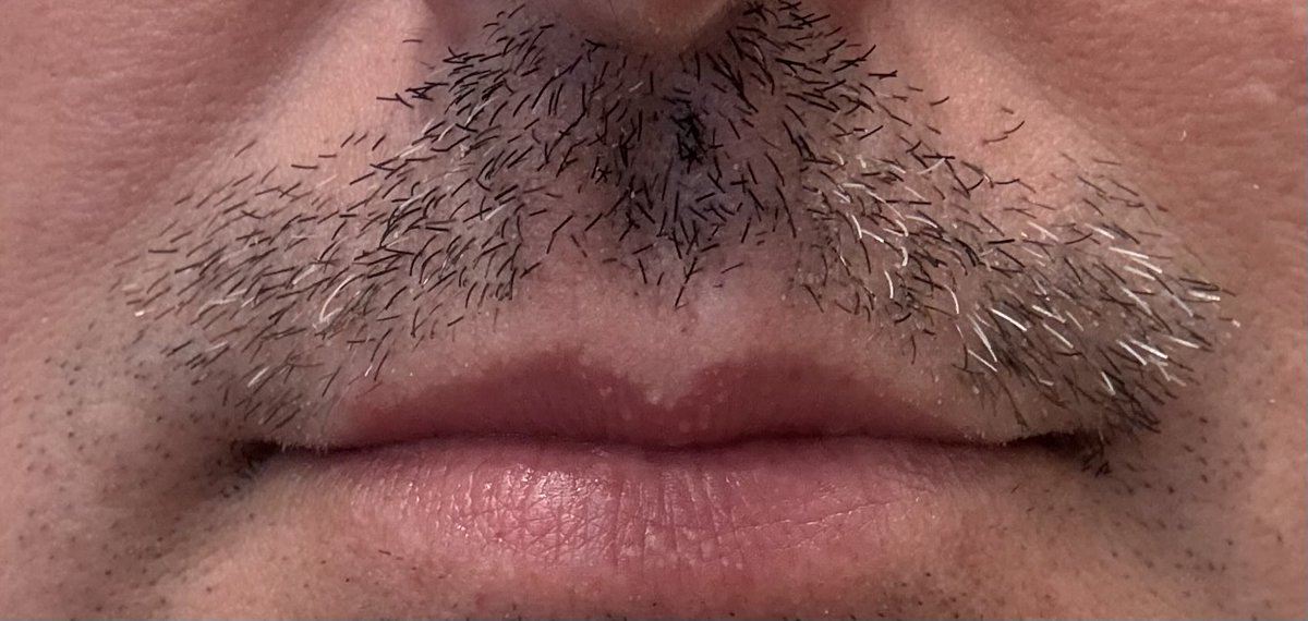 Day 6 of #NoShaveNovember