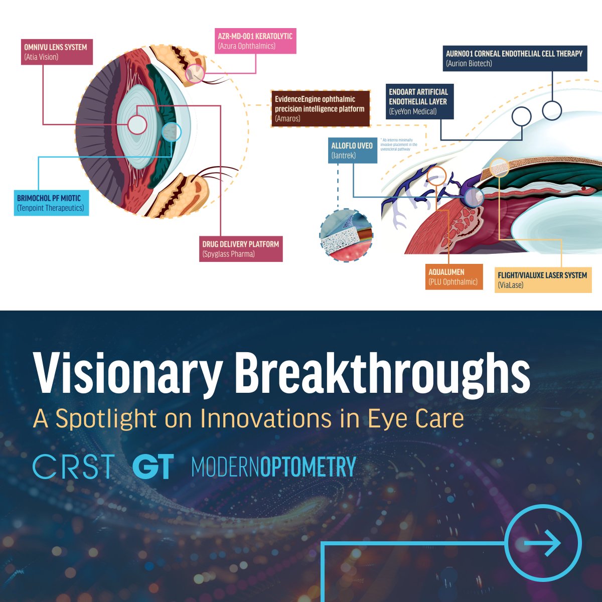 In a series of articles, leaders in ophthalmology innovation speak about the future of the field. In Visionary Breakthroughs, experts share their thoughts on the most exciting developments that are redefining the future of glaucoma care. ow.ly/vtif50XnrmA