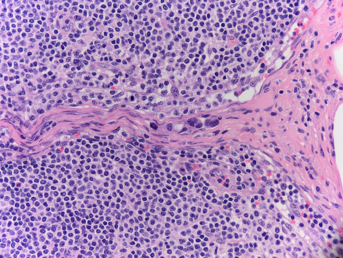 Quite subtle isolated tumour cells in a trabecular sinus.
#BreastCarcinoma
#pathology 
#SentinelNode 
💜