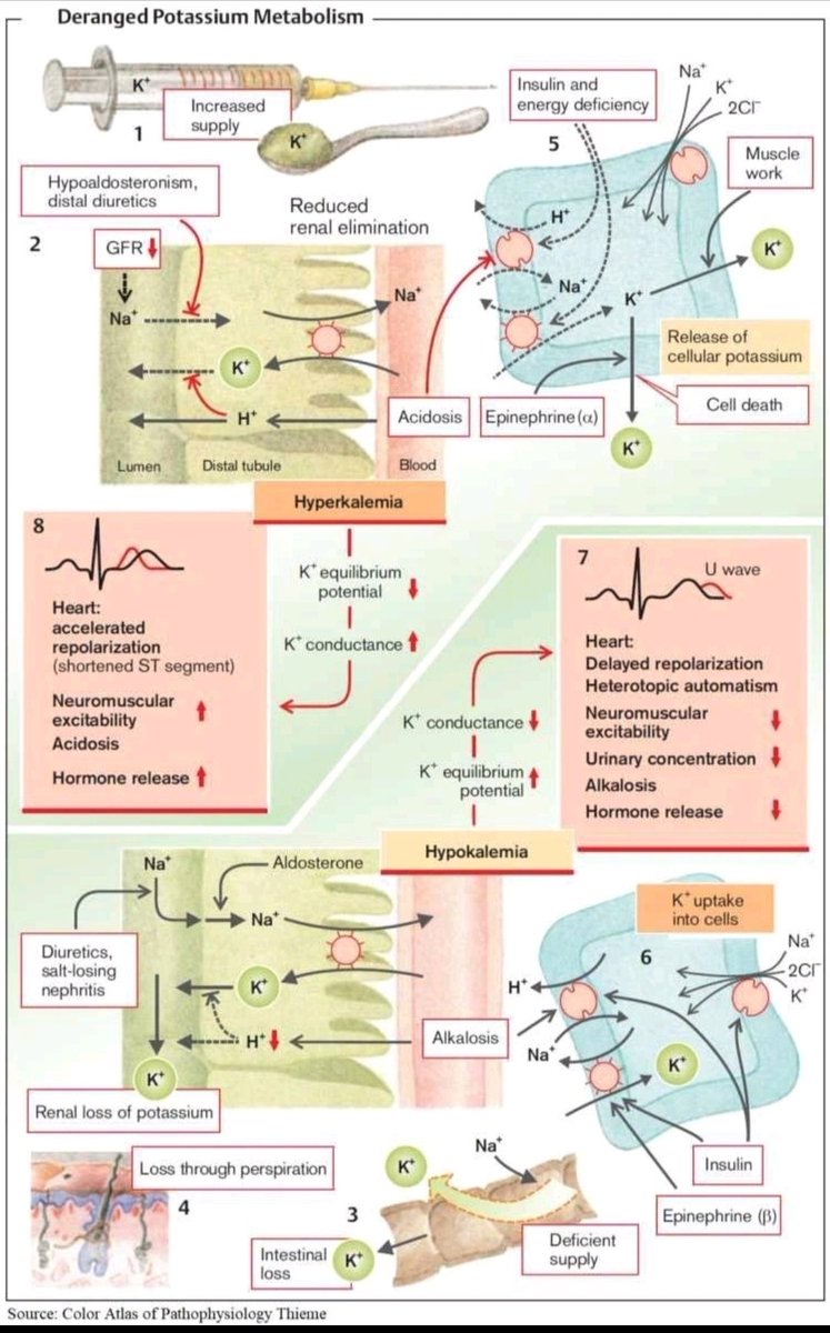 WilliamWallace's tweet photo. Potassium isn’t just another mineral; it’s the body’s electrical currency.

Here’s how it works 👇

1️⃣ Where Potassium Lives

About 98% of potassium is stored inside cells, while only 2% circulates in the blood.
This delicate balance is maintained by the sodium–potassium pump (Na⁺/K⁺-ATPase), constantly exchanging Na⁺ for K⁺ across cell membranes.
🟢 Think of it as the electrical wiring that keeps your heart and muscles firing properly.

2️⃣ What Regulates Potassium

Three main systems control potassium balance:

Kidneys: Excrete excess K⁺ under the influence of aldosterone.

Insulin: Moves K⁺ into cells after meals to prevent spikes.

Epinephrine: During stress or exercise, shifts K⁺ into cells to prevent dangerous elevations.
🟢 Example: After a workout, insulin and adrenaline work together to stabilize potassium levels.

3️⃣ When Potassium Is Too High (Hyperkalemia)

Potassium builds up in the blood when:

The kidneys can’t excrete it (e.g., kidney disease, low aldosterone).

Acidosis pushes K⁺ out of cells.

Tissue damage (burns, trauma) releases stored K⁺.

🟢 Result: Overexcited cells, erratic heart rhythm, and, in severe cases, cardiac arrest.

4️⃣ When Potassium Is Too Low (Hypokalemia)

Potassium drops when it’s lost or driven into cells:

Losses: Diuretics, vomiting, diarrhea.

Shifts: High insulin or alkalosis (low blood acidity).

🟢 Result: Fatigue, muscle cramps, and heart rhythm irregularities, often seen in patients using loop or thiazide diuretics.

5️⃣ How Potassium Affects the Heart

Potassium determines how quickly heart cells reset between beats:

High K⁺: Speeds up repolarization → shortened ECG segments, risk of arrhythmia.

Low K⁺: Delays repolarization → “U waves” on ECG and reduced cardiac output.
🟢 Both extremes can be life-threatening — that’s why cardiac patients’ potassium is tightly monitored.

6️⃣ Why Balance Is Everything

Potassium balance reflects kidney function, hormone regulation, and acid–base status.
Too little or too much disrupts the body’s electrical equilibrium, affecting the heart, nerves, and metabolism.

🟢 Example: Diets rich in potassium (bananas, spinach, sweet potatoes) support normal blood pressure and heart rhythm.

Maintaining balance through healthy kidneys, adequate diet, and careful medication management keeps every beat, movement, and thought running on schedule.