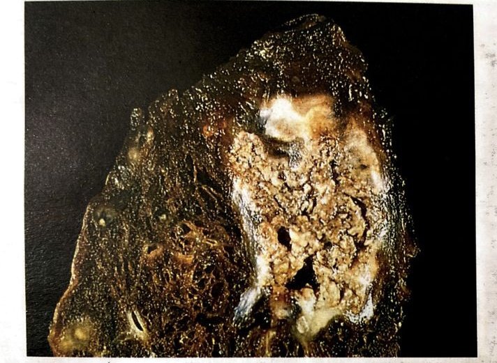 drabdulhameed07's tweet image. Q:Caseous necrosis is classically seen in ?

A. Syphilis
B. Tuberculosis
C. Leprosy
D. Sarcoidosis
#Necrosis #pathology #Medpath