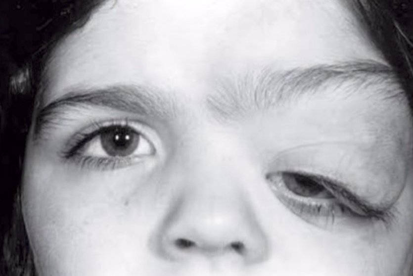 nervemed's tweet image. What is the most likely diagnosis❓

A. Marfan&apos;s Syndrome
B. Neurofibromatosis
C. Tuberous Sclerosis
D. Mikulicz&apos;s Syndrome