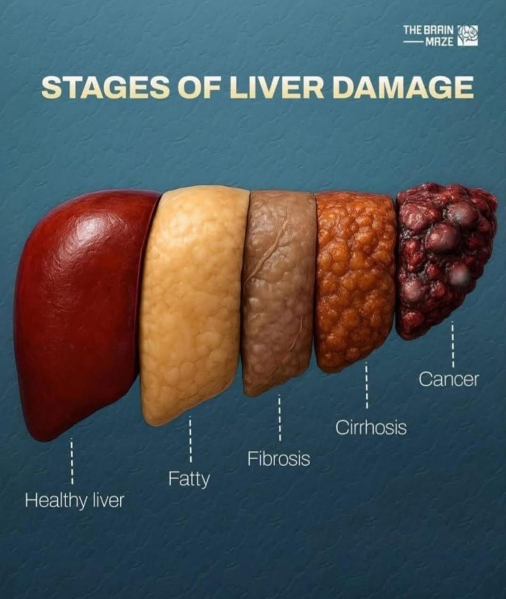 Чимээгүй алуурчин: Таны гэдэс аль "шат"-ндаа явна вэ?

Монголчууд бидний хамгийн том дайсан бол Элэгний хорт хавдар (Дэлхийд №1). Гол буруутан нь B, C вирус, дээр нь нэмээд архи, өөх тостой хоол.

Элэг бол таны биеийн "Хими цэвэрлэгээ". Бүх хорыг шүүж, идсэн хоолыг энерги