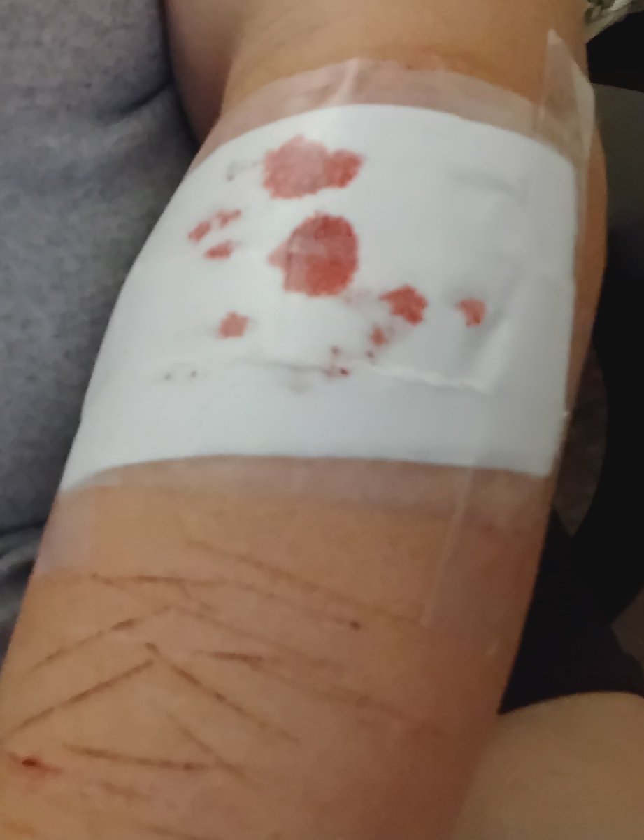 junkbltch's tweet image. still bleeding a bit? they aren't deep, i think i keep irritating them cause i anxiety scratch