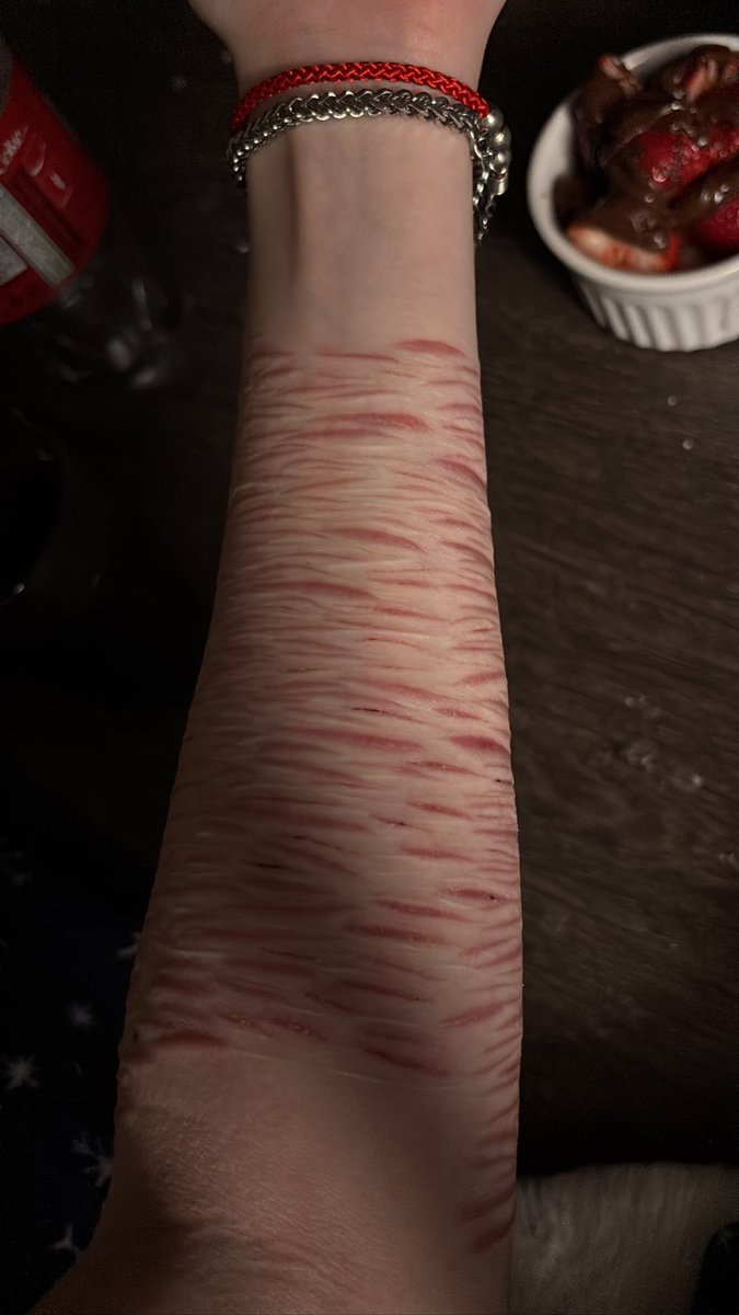 biolaseryuri's tweet photo. I love my scars they’re so pretty https://t.co/qI3CPw3lHD