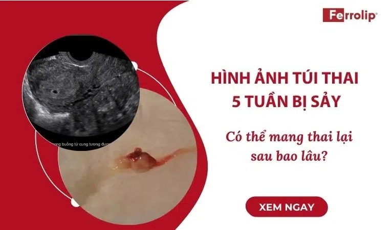 dsminhferrolip's tweet image. 10+ Hình ảnh túi thai 5 tuần bị sảy

➡️➡️➡️ ferrolip.vn/hinh-anh-tui-t…

#ferrolipbau #ferrolip #satbaovinang #xegoitrungvang #satfebaufe