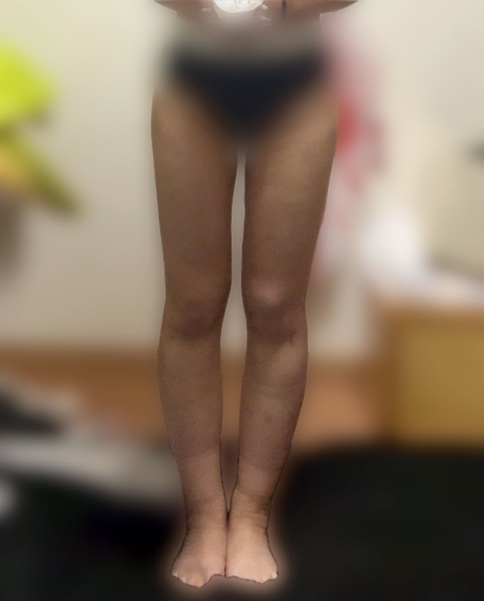 mi_woo28's tweet photo. レアートさんで太もも、ヒップライン脂肪吸引して3週間経過しました。
特に太ももの付け根が目に見えて細くなっていて感動🥹✨
日に日に細くなっていくのでこれからの経過が楽しみです！
#レアート　#ソ院長 https://t.co/QCk9XO1Rns