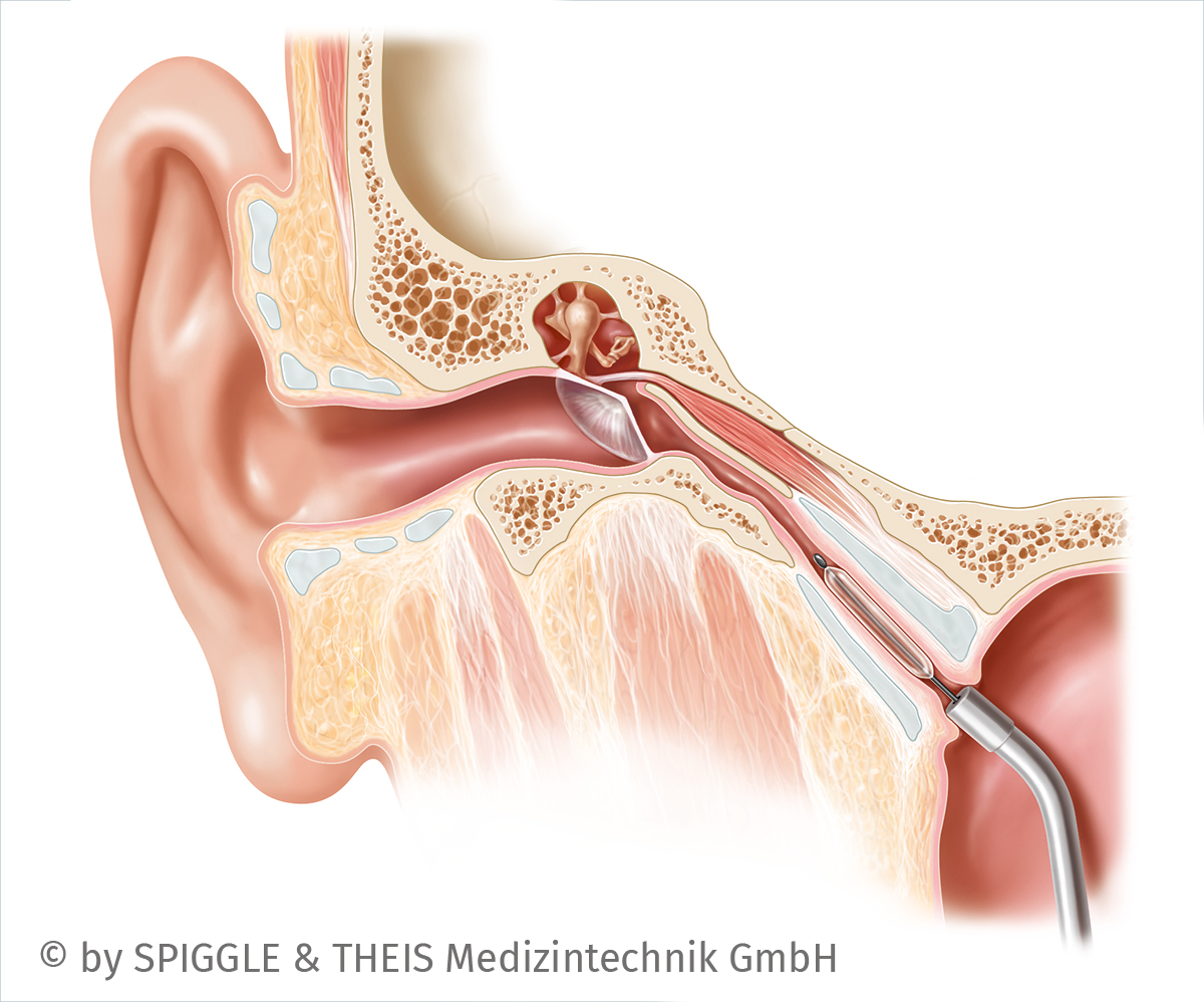 DpMedical's tweet photo. Earlier this year, DP Medical was proud to be appointed exclusive UK distributors of SPIGGLE &amp; THEIS Medizintechnik GmbH. 

You can view the full SPIGGLE &amp; THEIS #ENT range on our website, now: https://t.co/Zolr9F6Dci https://t.co/rkvL6NgZpa