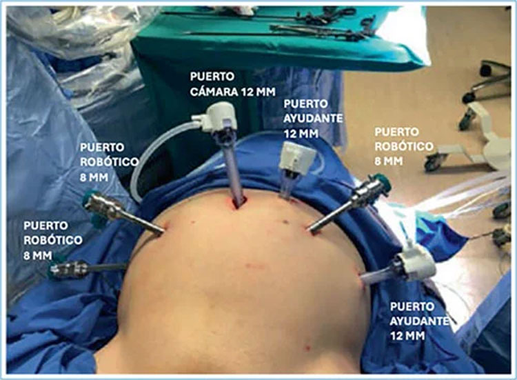 Urolchi's tweet photo. Dr. Raimundo Domínguez presentó su trabajo de ingreso a #SCHU, mostrando que la clipless-PRR es una técnica segura, reproducible y con excelentes resultados oncológicos y funcionales a 1 año. https://t.co/hkNL2astVr
#RevistaSCHU https://t.co/wKeM1iAP9k