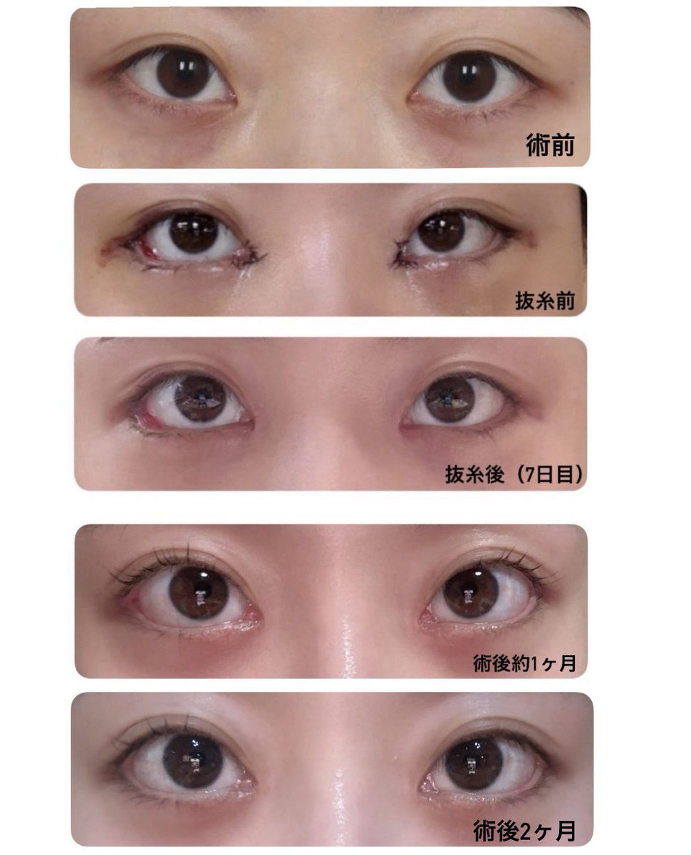 li_04_0's tweet photo. 【instar整形外科】さんで 『目上切開』『目尻切開』『目下切開』『目の脂肪再配置』をして約2ヶ月✨
全体的に目が大きくなって嬉しいです🥺💗💗
目上切開の傷も治ってメイクするのが楽しいです🎀
不安なことは聞くとすぐ返信くるので安心でした👶🏻
@instarjp #目尻切開 #タレ目形成 #目上切開 https://t.co/JvIXJusGbE