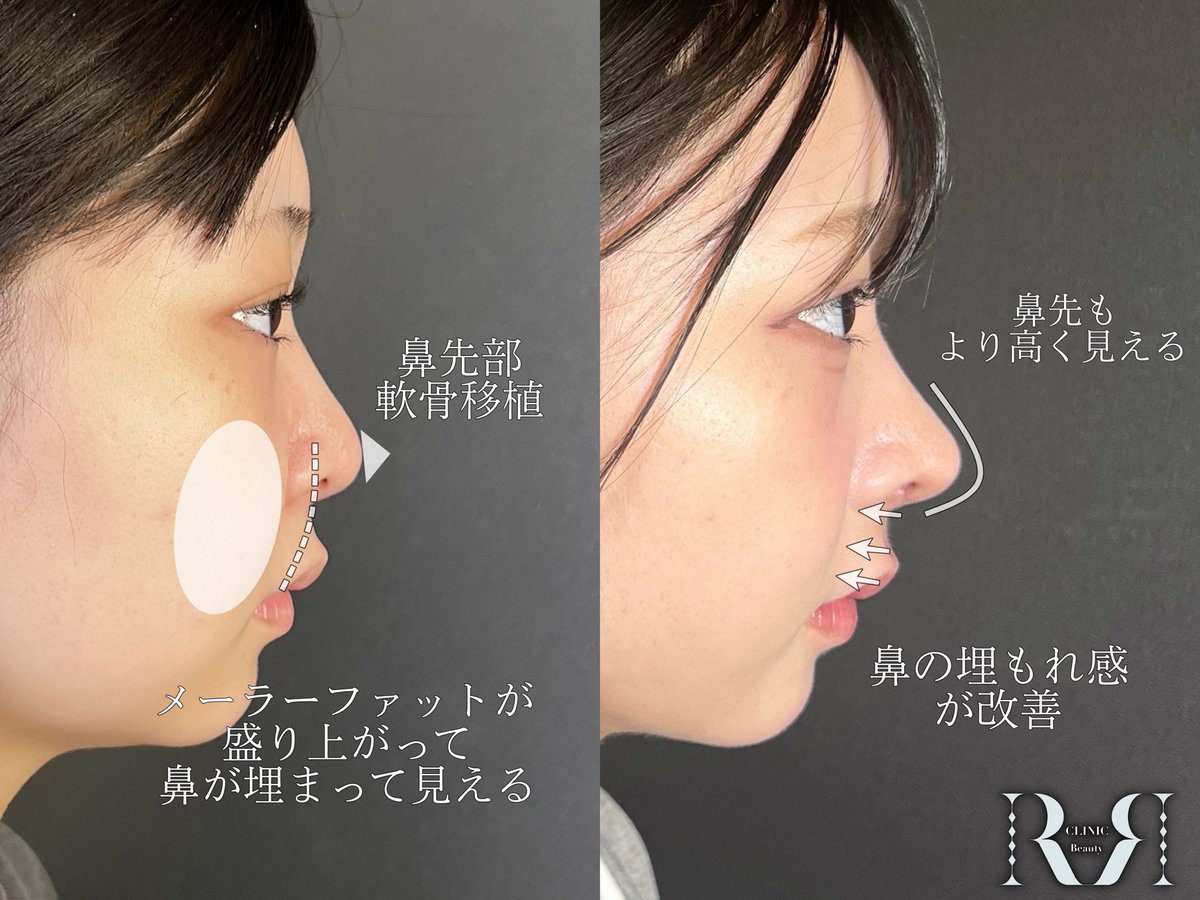 忘れ鼻の美容外科医 Dr小池 tweet media