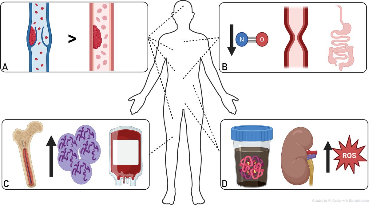 Paroxysmal Nocturnal Hemoglobinuria (PNH) <a href="/MayoProceedings/">Mayo Clinic Proceedings</a> <a href="/MayoHemeOnc/">Mayo Clinic Hematology-Oncology Fellowship</a> <a href="/aamdsif/">AA&MDSIF</a> 

mayoclinicproceedings.org/article/S0025-…
